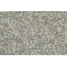 DEL人间变性大细胞淋巴瘤细胞